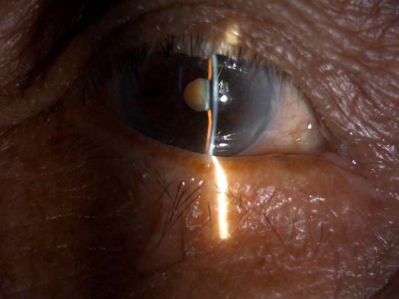  从术前近乎无视力到术后视力0.6，佛山爱尔眼科助八旬老人驱散白内障阴霾(图1)