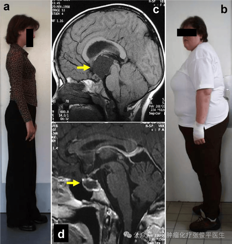 文献学习||颅咽管瘤：何去何从？