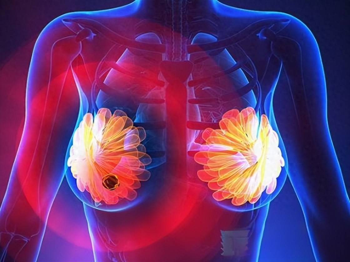 原创            得了乳腺癌？别怕，可防可治可愈，早期治愈率超过80%