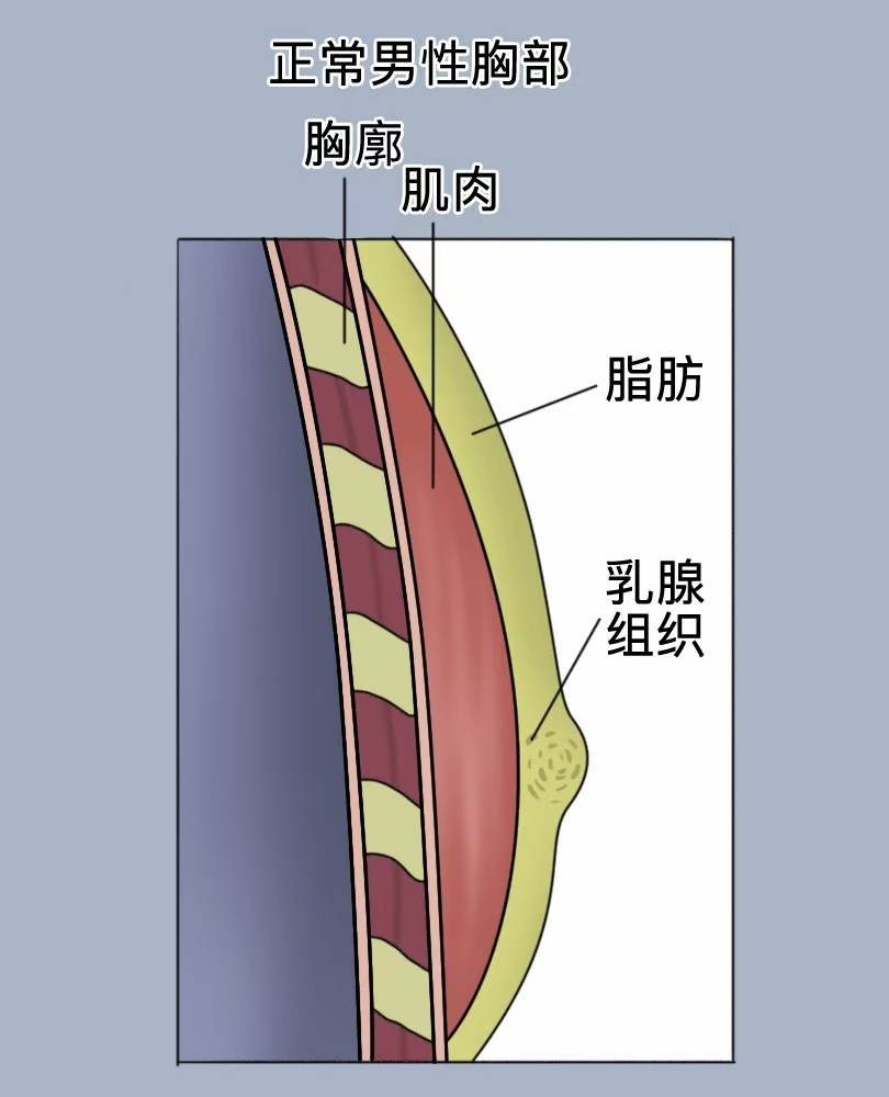 男生胸大不是胖！男性乳房缩小：告别“男乳”尴尬，重塑平坦胸膛
