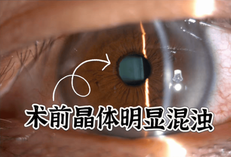 53岁男子摆脱700度高度近视+白内障，佛山爱尔眼科三焦点晶体助其重返清晰视界(图2)