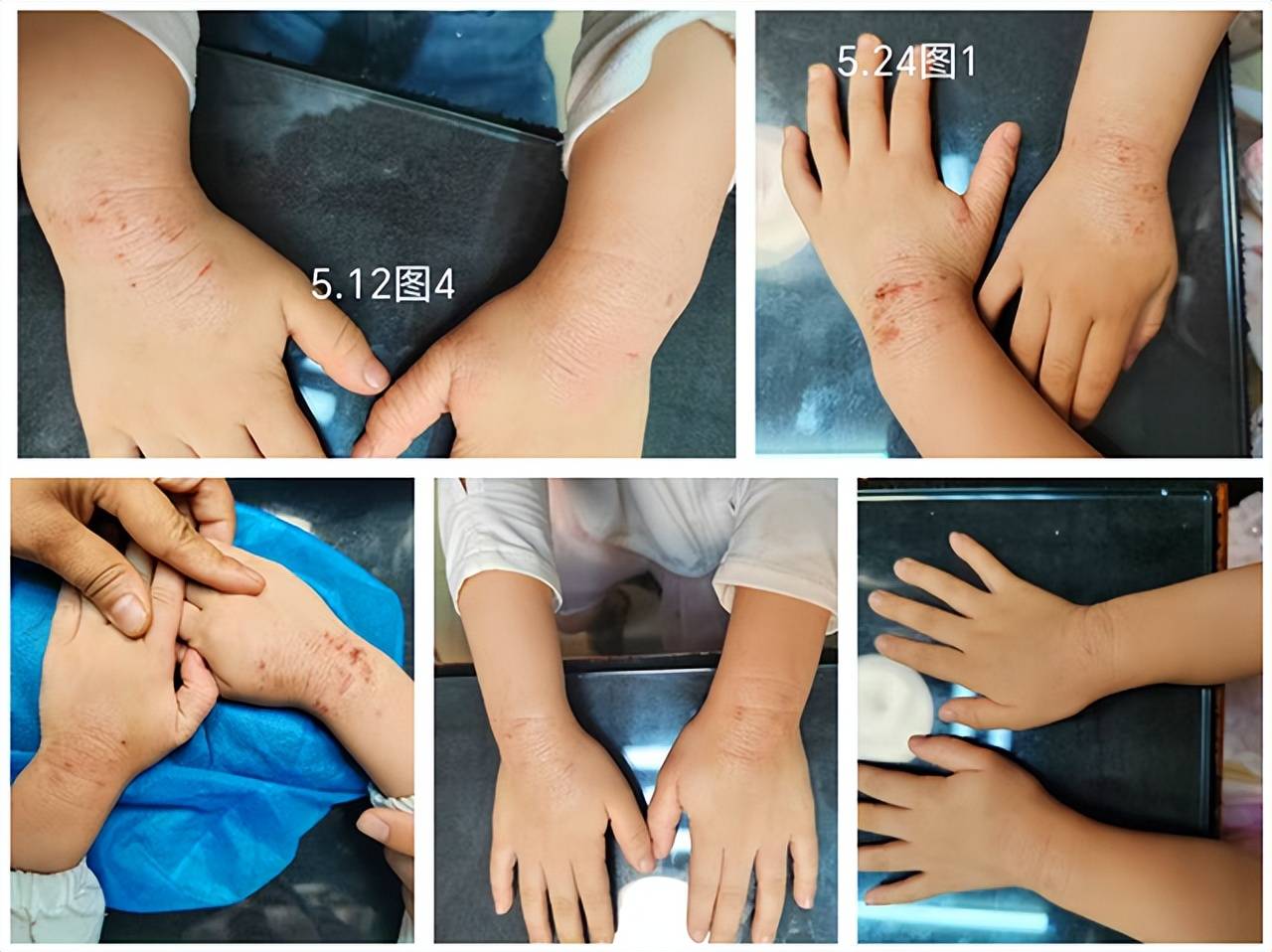 1个方子调了7次，4岁湿疹患儿终于不挠了，陕师大天桥下的中医这样做