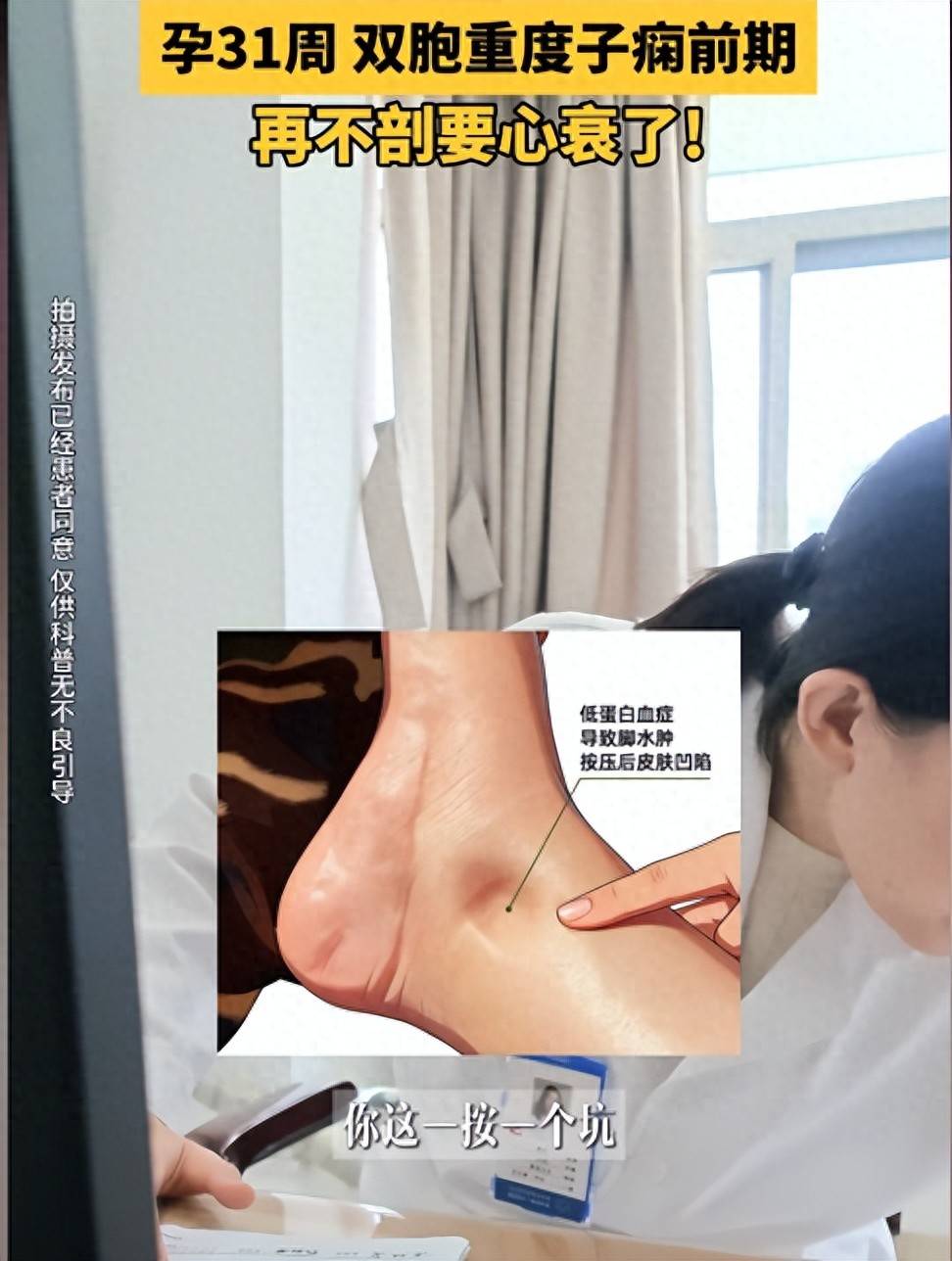 31周双胞胎孕妈眼睛突然看不清,脚肿,医生：等不了胎儿成熟,马上手术,再等就要