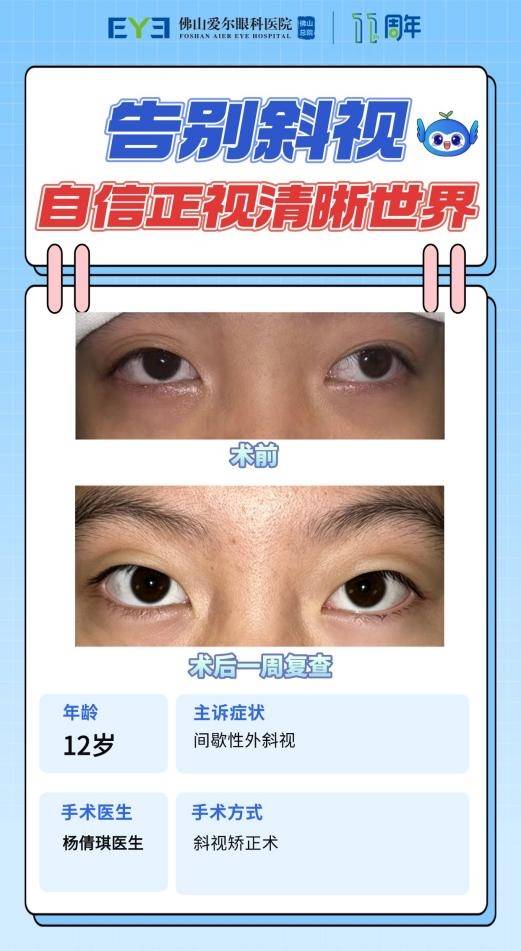 佛山爱尔杨倩琪医生提醒:斜视——别让“长大就好”耽误孩子(图1) 佛山爱尔杨倩琪医生提醒:斜视——别让“长大就好”耽误孩子(图1)
