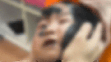 年仅2岁“兽皮痣”患儿乐宝因痣体癌变离世