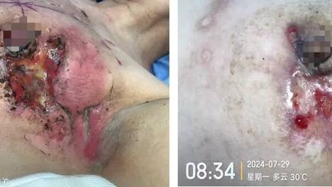 癌性伤口并发金葡菌感染，这样换药效果不错
