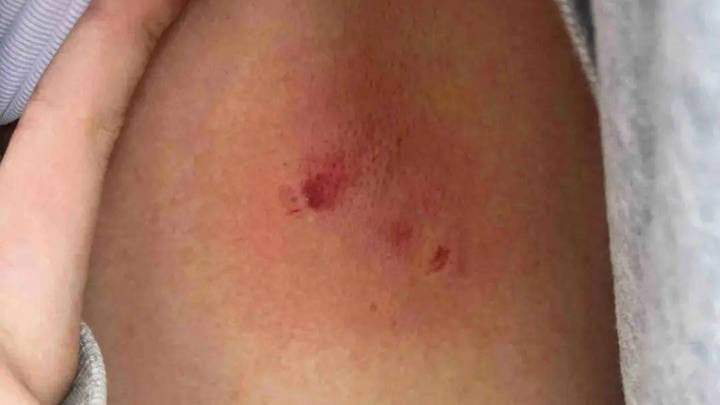 黔灵山公园猕猴咬伤游客背部，是否应该报销狂犬疫苗费用？