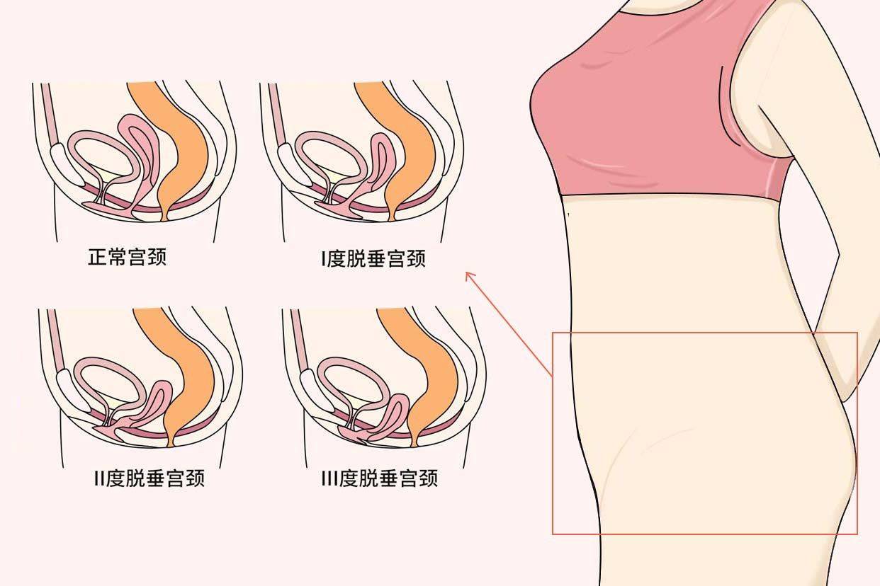 术后可以恢复患者膀胱颈后尿道的正常解剖位置,增加后尿道内压力,提高