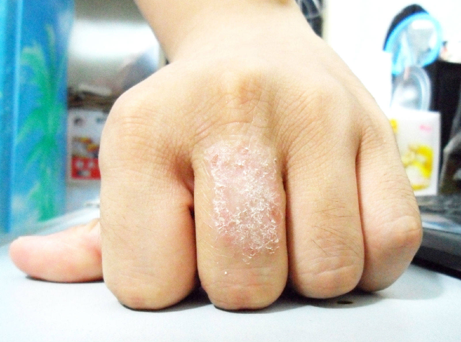长沙鸿业皮肤专家曝光:慢性湿疹
