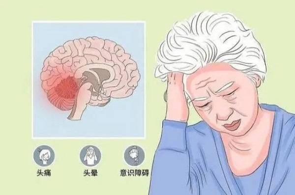 【精选】小脑萎缩怎么办?田卫东大夫:滋肾荣脑汤三步针对调理改善!