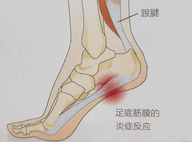 頸肩肌筋膜炎頸,肩,背部出現廣泛的疼痛,酸脹,沉重,麻木,肌肉僵硬