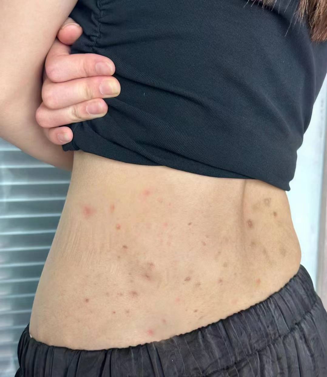 你的红疹干痒为什么一直反复,2分钟教会你如何消疹,好