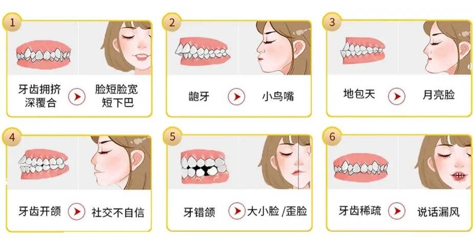 導致牙齒重疊或錯位;另一種是前牙反頜,即下頜前牙咬合在上頜前牙的