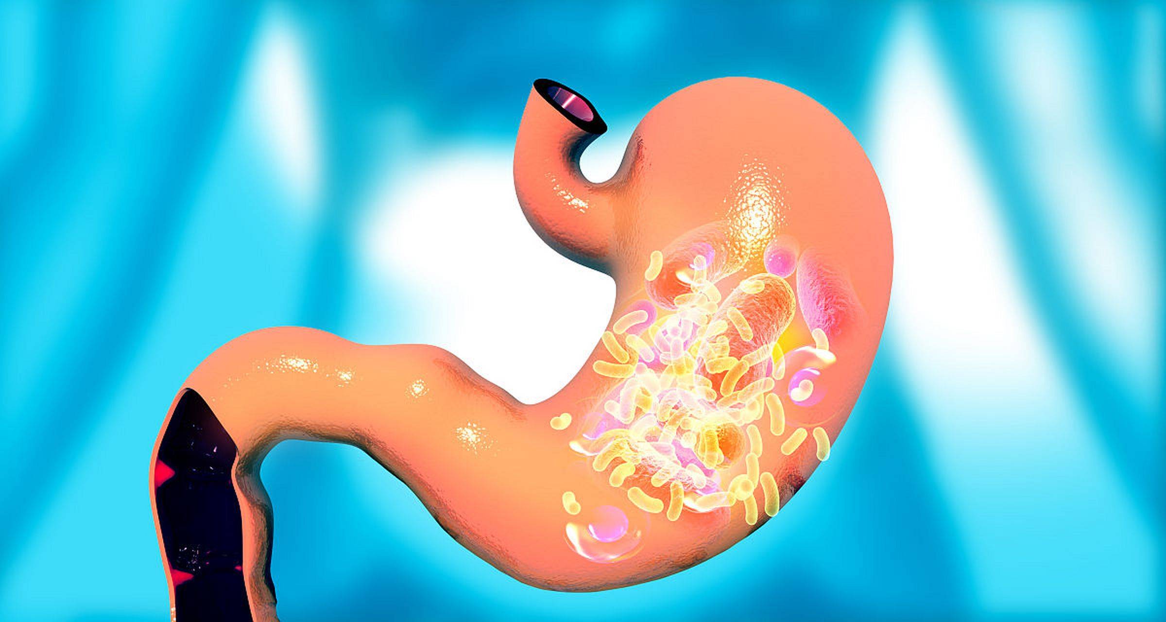 【新发现】大剂量艾司奥美拉唑镁治疗幽门螺杆菌的疗效优于传统四联