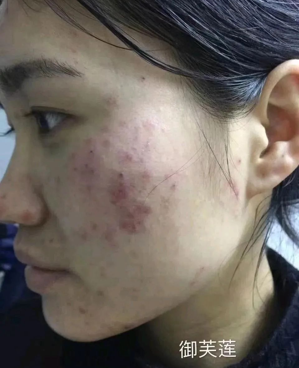 御芙莲护肤知识之痘痘篇_油脂_皮肤_祛痘