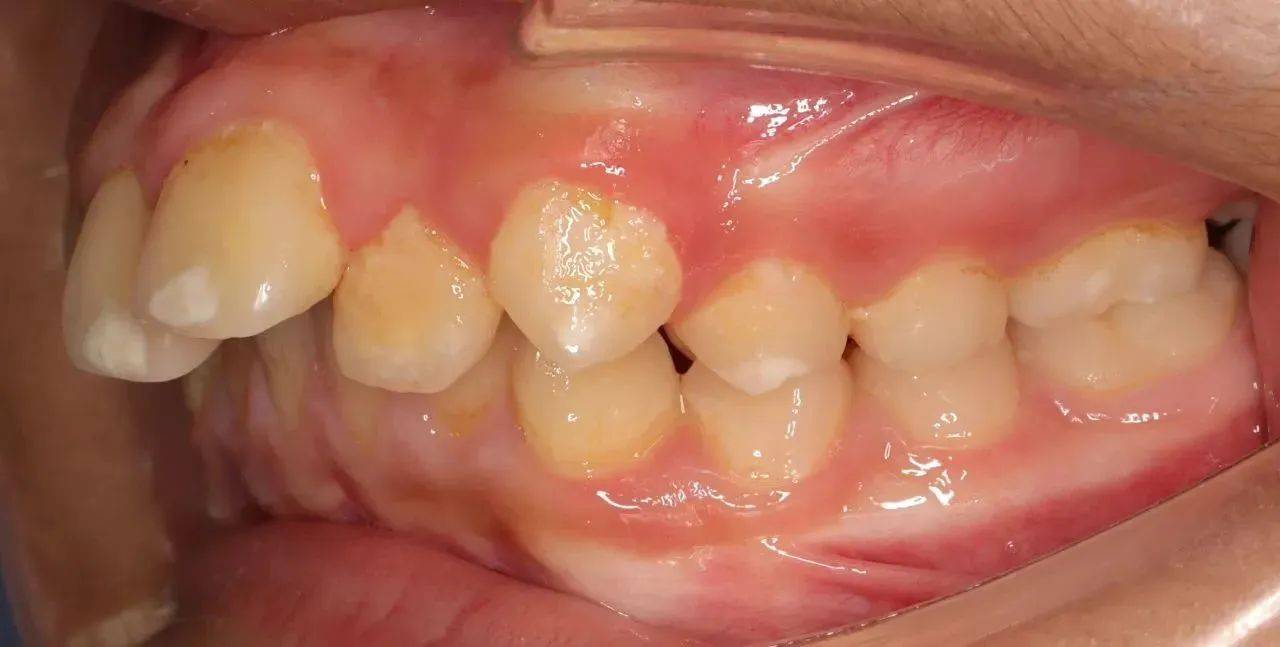 牙齿矫正一定要拔牙吗?钱塘牙科:牙列拥挤,龅牙等3种情况需注意!