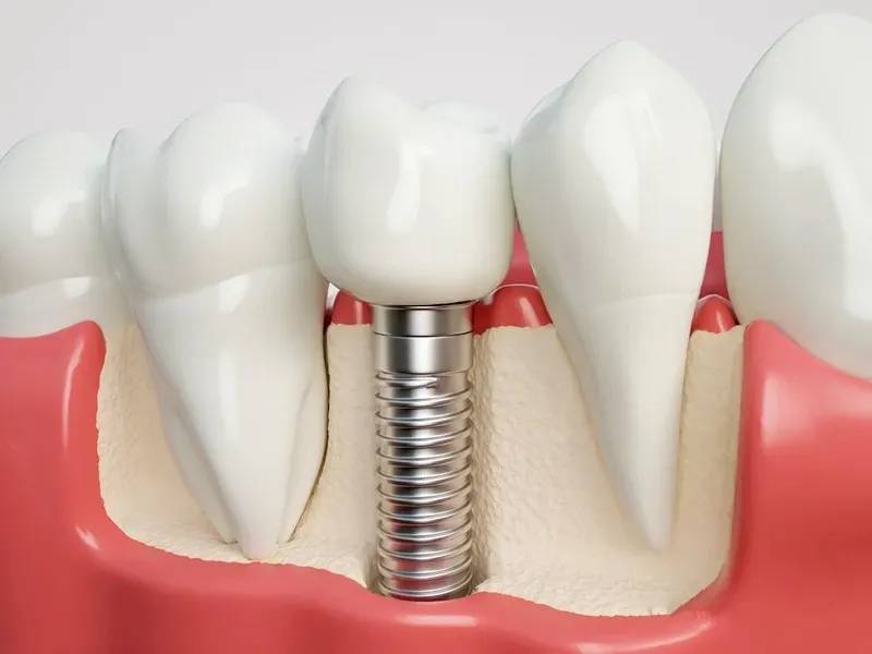 全口假牙可以换种植牙修复吗