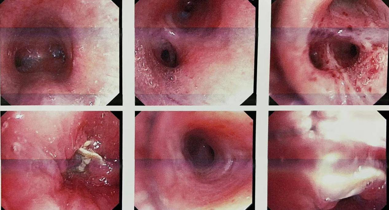 咳嗽气短竟是肺里长了茄梗