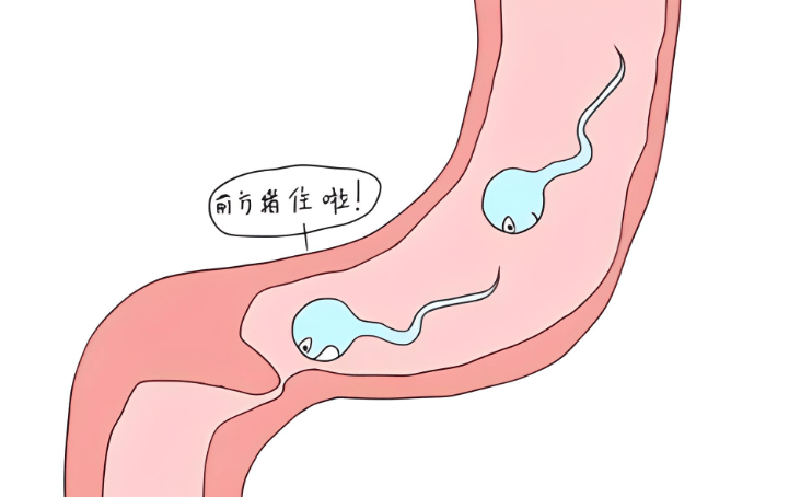 附睾炎导致输精管堵塞吗