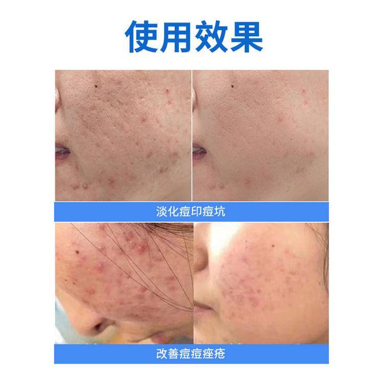 海绵微针原料oem厂家分析:海绵微针做一次有效果吗_进行_皮肤_治疗