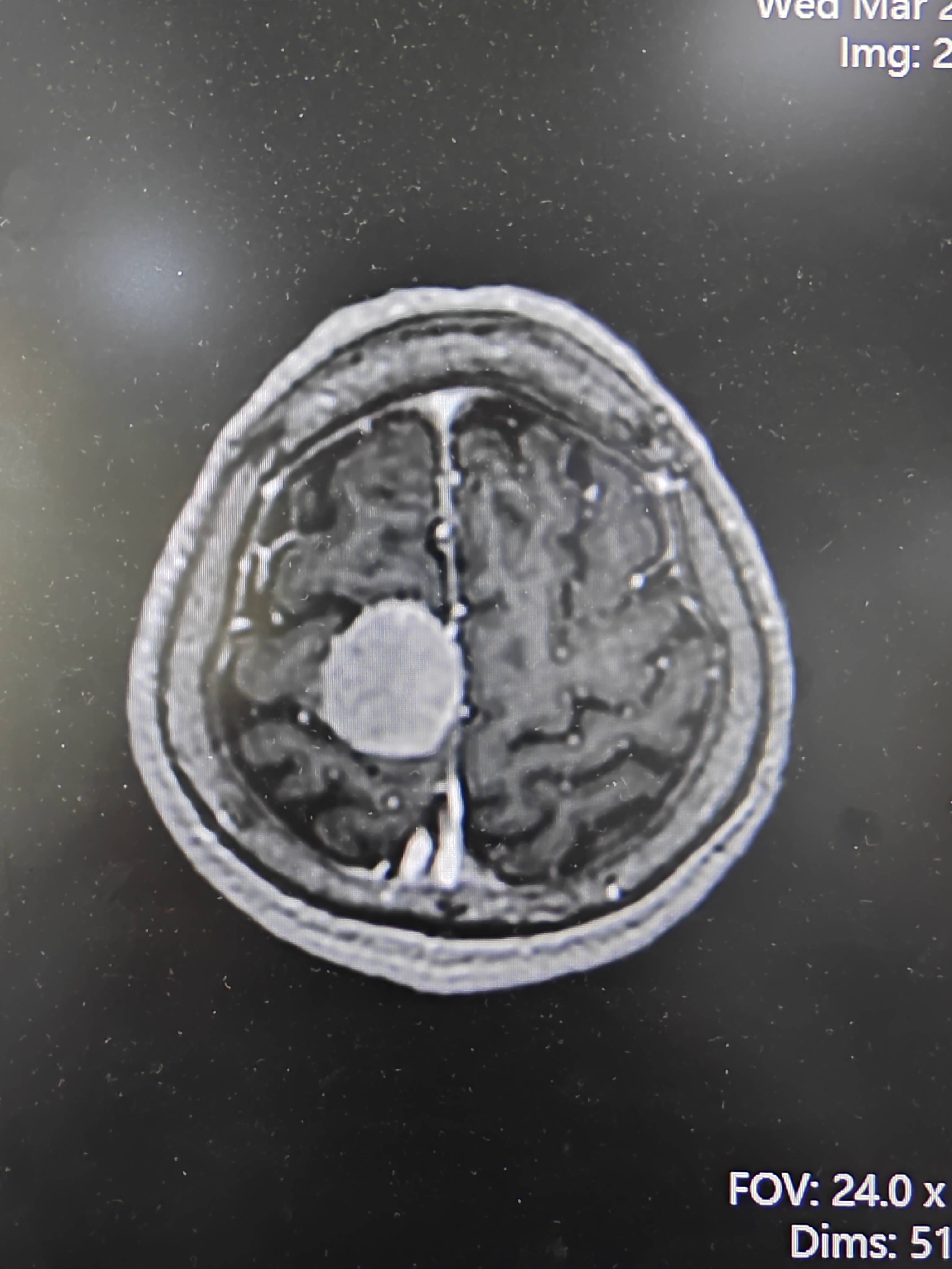 全国肿瘤防治周专题:她的经历告诉大家脑膜瘤别误诊误治!