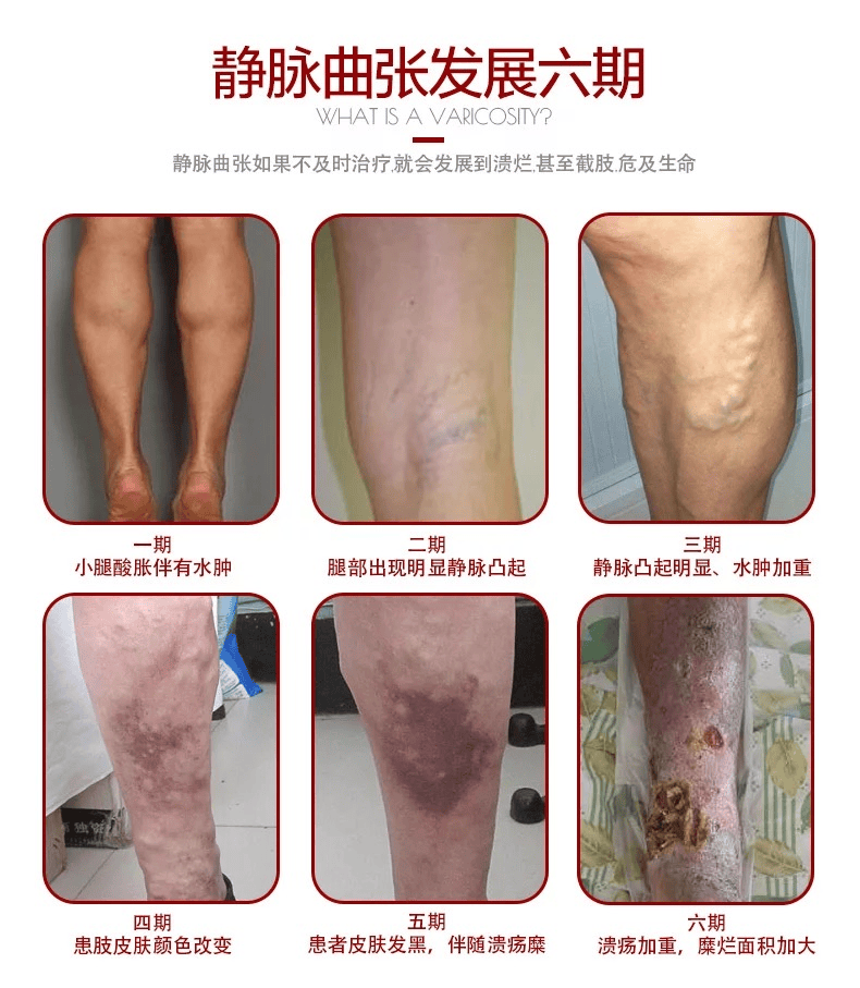 患有下肢静脉曲张要及时治疗#陕西冶金医院血管外科_运动_进行_患者