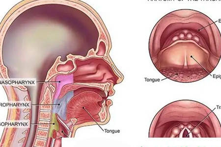 喉咙里面有瘤子怎么办图片