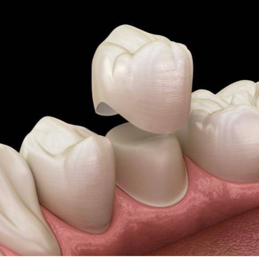 为什么做完根管治疗,牙齿还要包牙套?