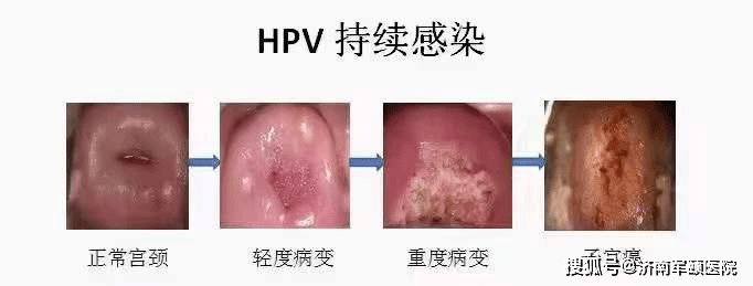 hpv传染性强吗 来自搜狐网
