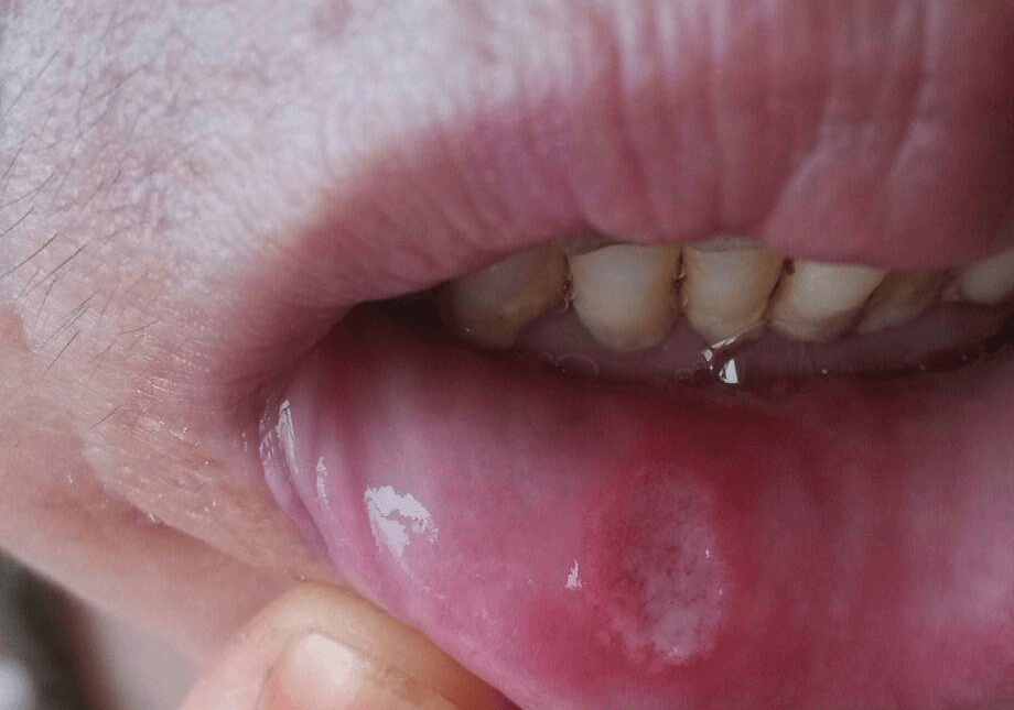 口腔溃疡好转的迹象图图片