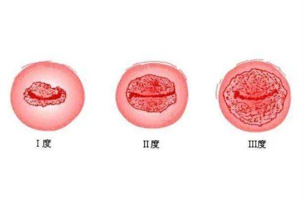 宫颈图片颜色图片