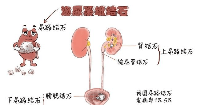 输尿管结石怎样排出图片