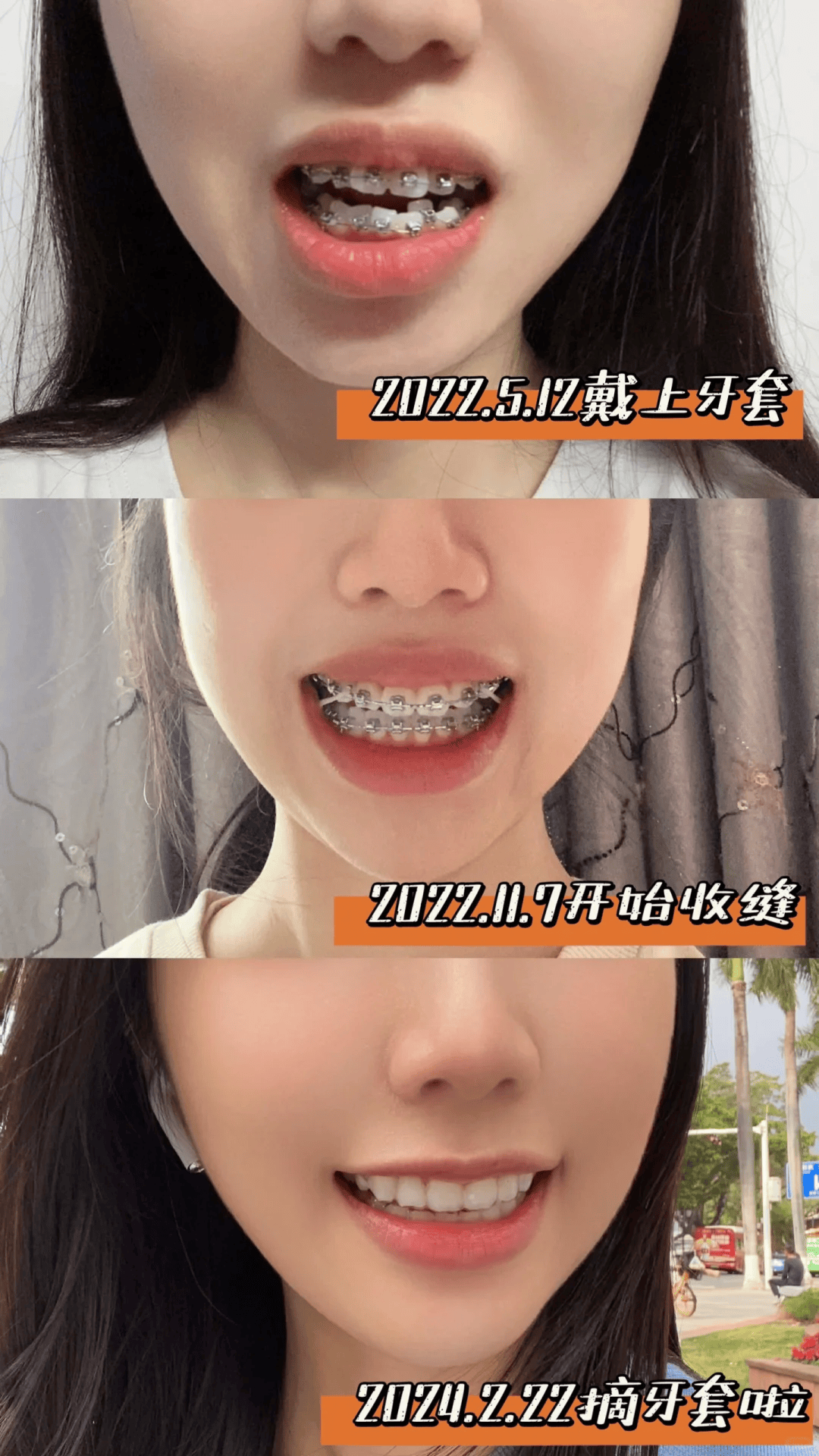 坐标邢台,女大学生牙齿矫正效果,大家看看行不行?