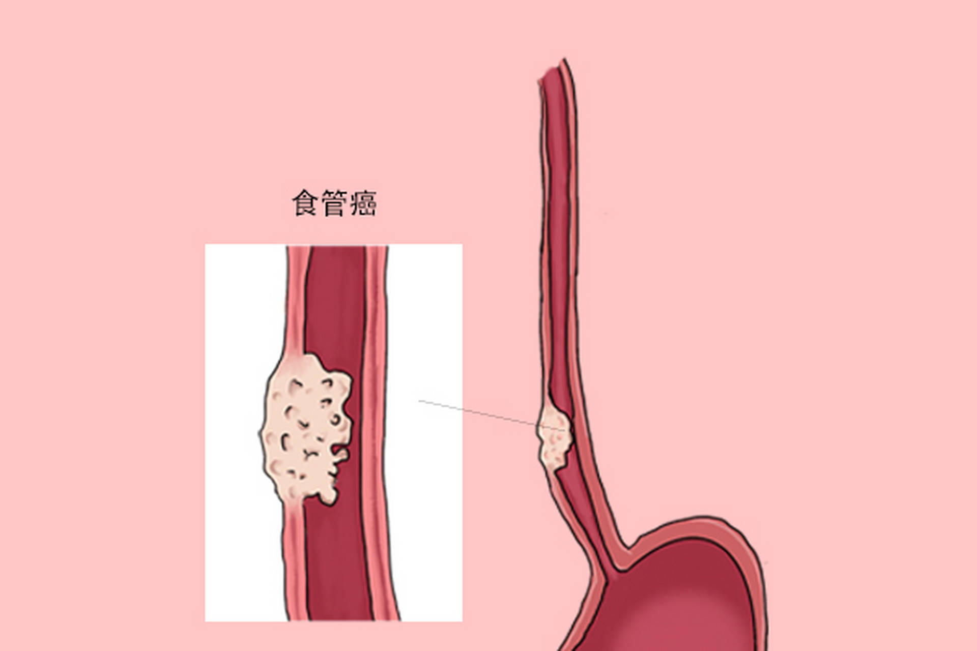 长期的不良饮食习惯