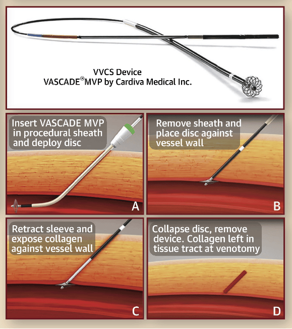 行业研究|盘点5种血管封堵器_闭合_exoseal_定位器