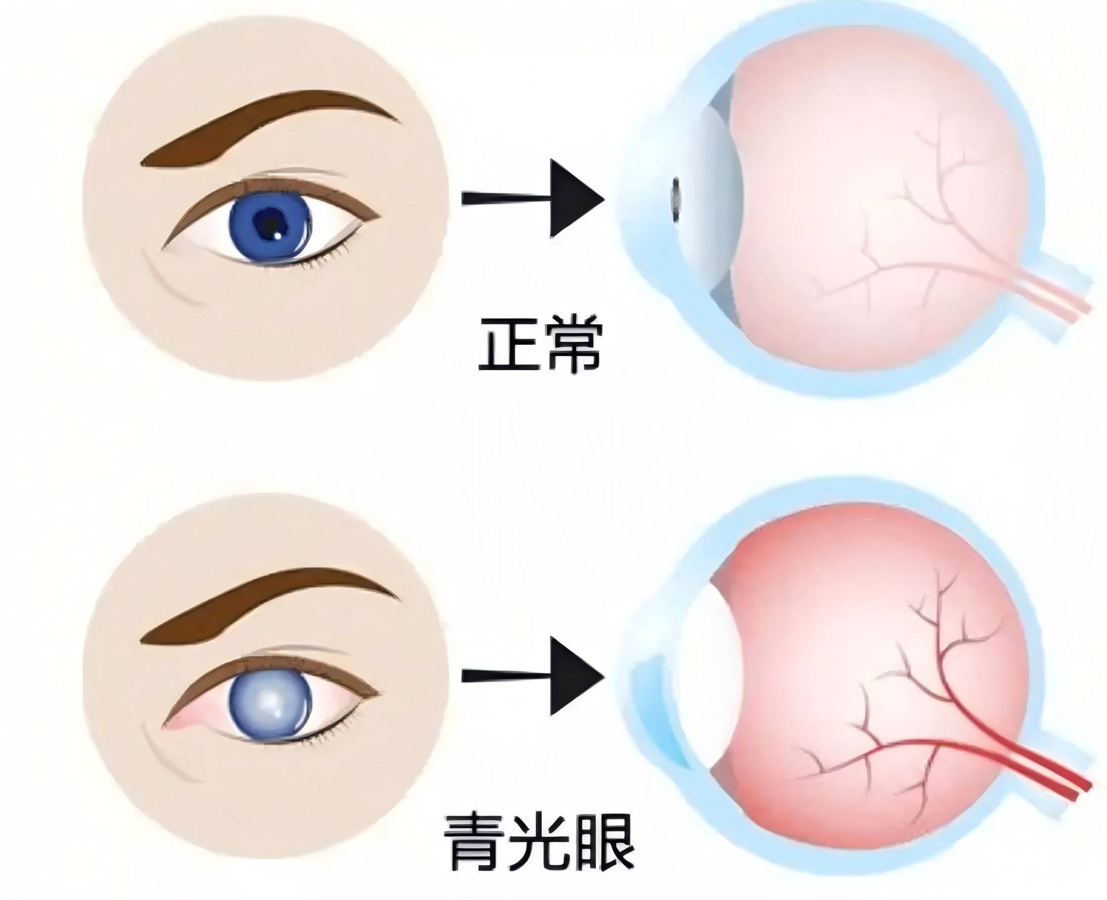 眼病的种类及症状图片图片