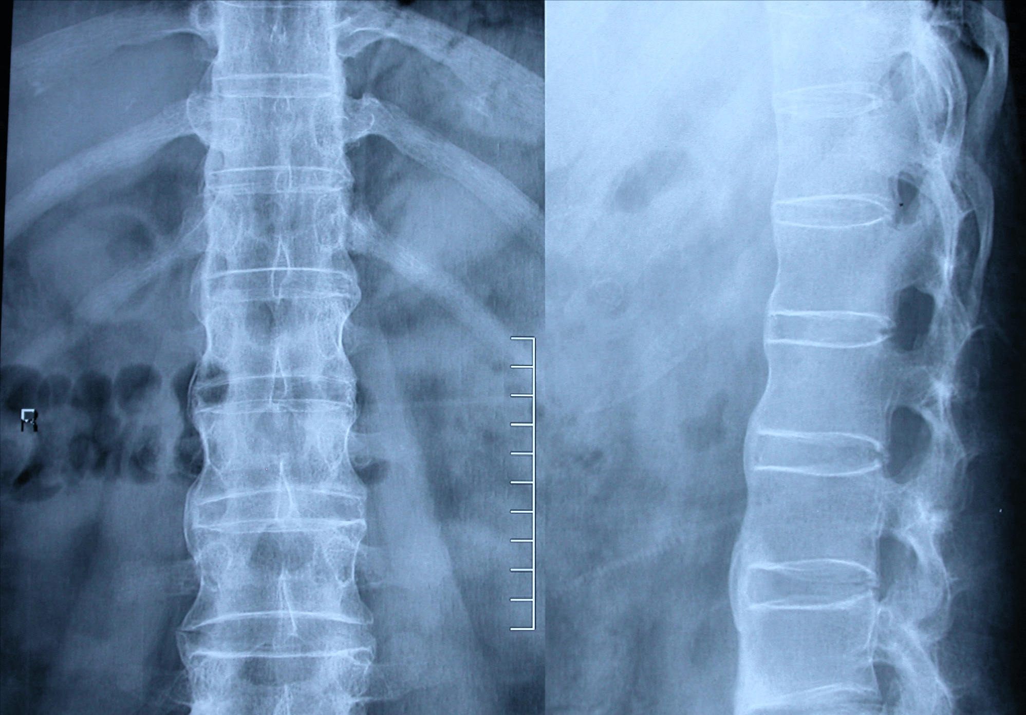 多年的强直性脊柱炎疼痛,中药热敷就能治好了?