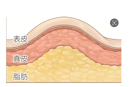 皮下脂肪增厚的图片图片