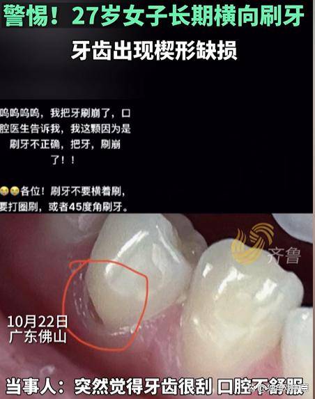 27岁女子长期横向刷牙致牙齿缺损:正确刷牙方式关乎口腔健康