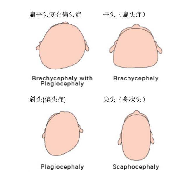 中国北方为何会有睡扁头的习俗?这可太奇怪了