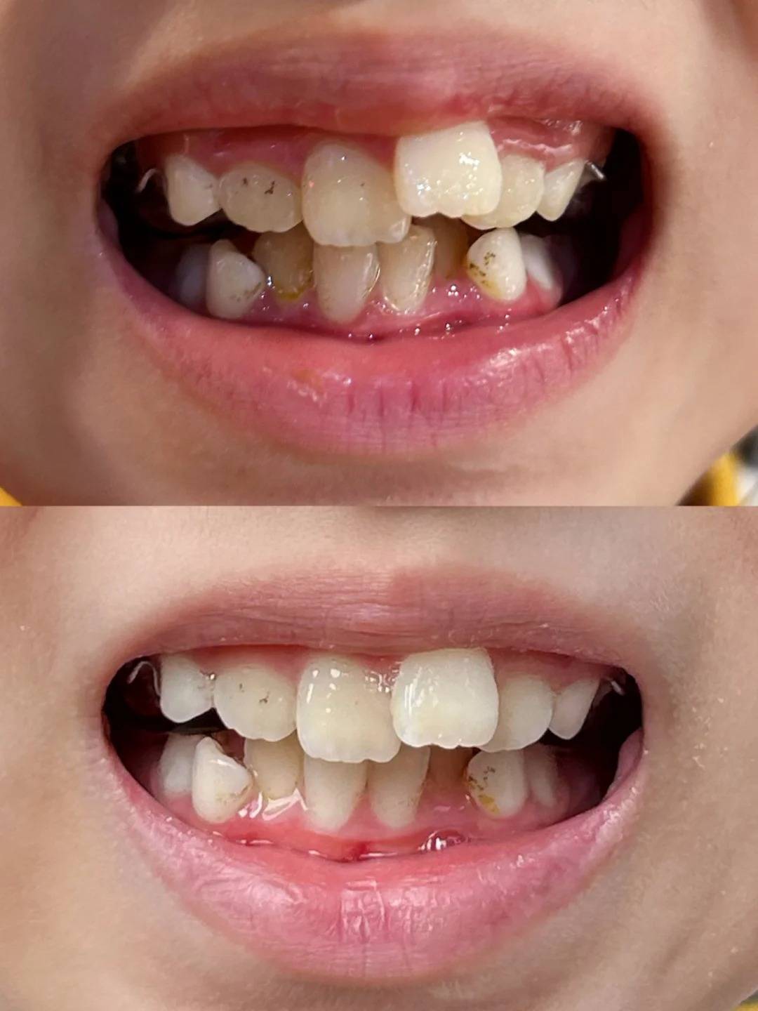 邢台正畸专家:如何预防儿童牙齿拥挤?