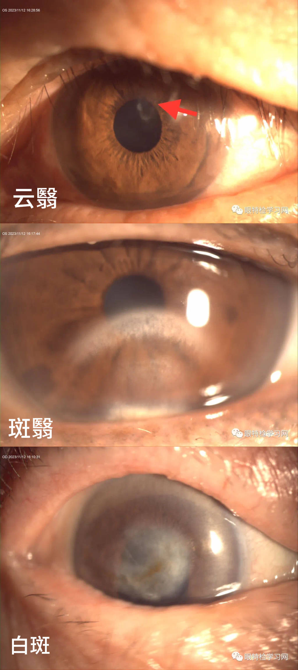 是谁偷走了他近视激光手术的机会?