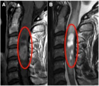 脊髓髓内室管膜瘤诊治解析：35岁患者从确诊到康复的全过程