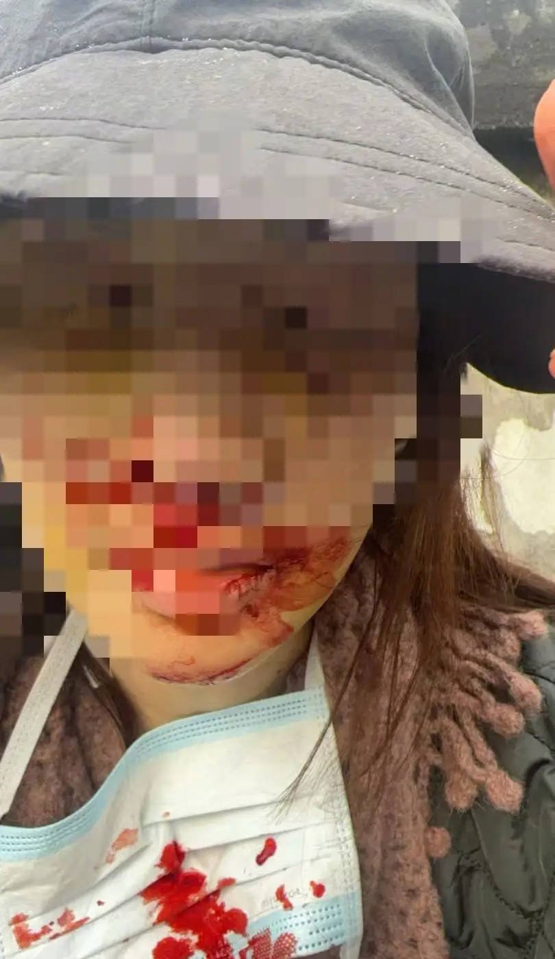 金晨自曝车祸事故现场照！面部受伤严重满脸鲜血情况危险