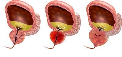 男人前列腺病变的一些表现