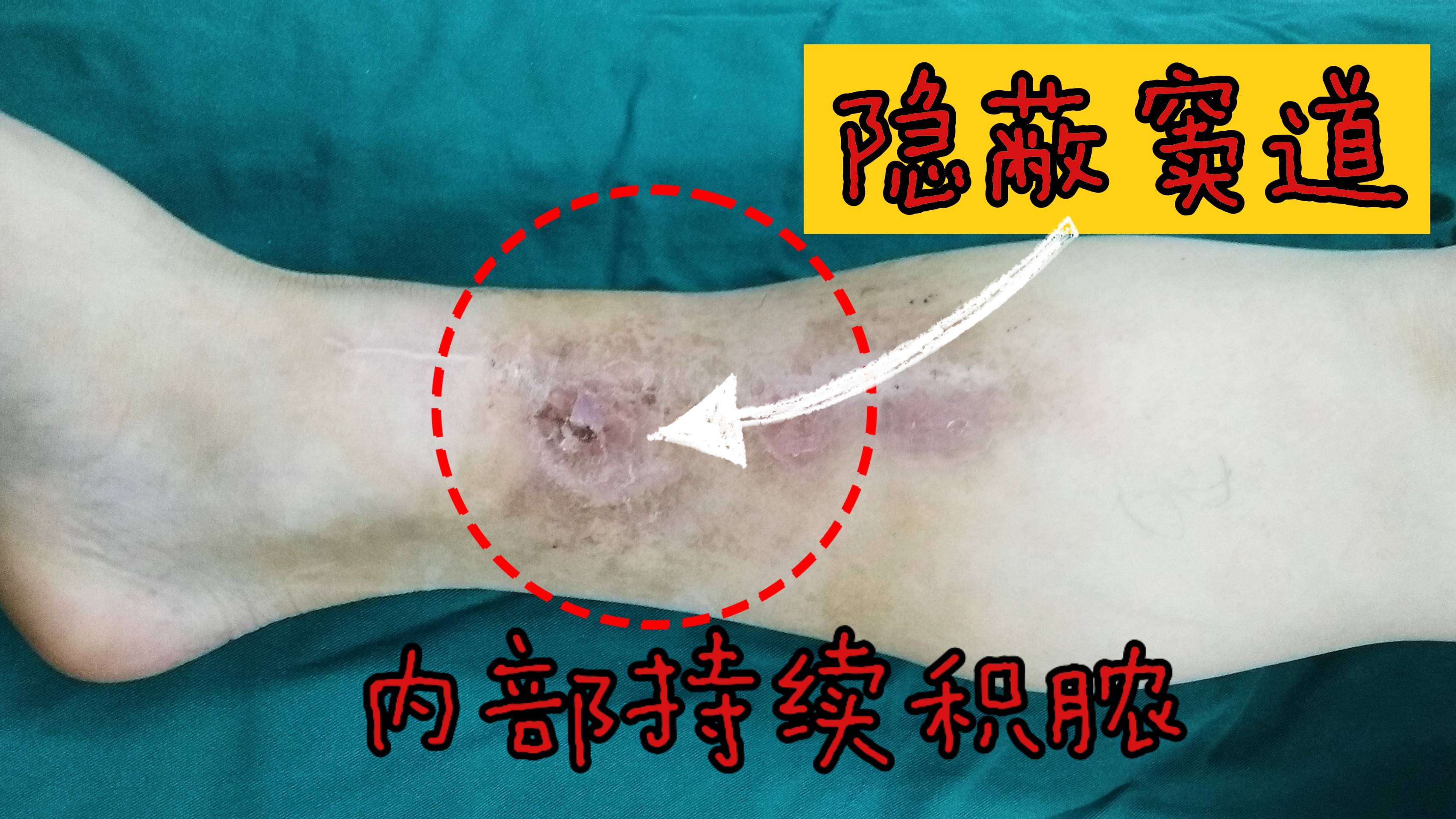 伤口看着不大，怎么就拖成了骨髓炎？这3个危险信号，一定要警惕