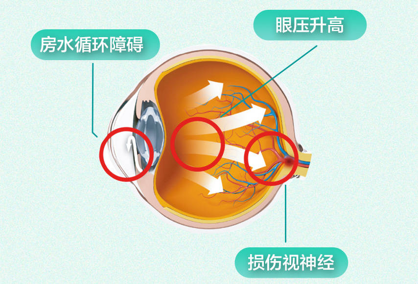 眼睛不痛不痒、视力1.0，为什么也会查出青光眼？