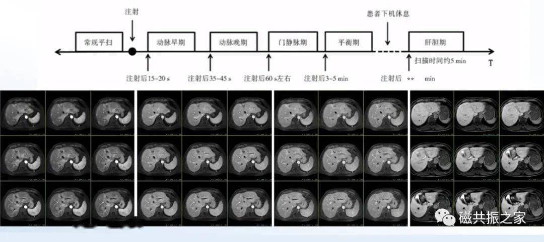 掃盲:上腹部 mrcp該如何掃描!_序列_檢查_線圈