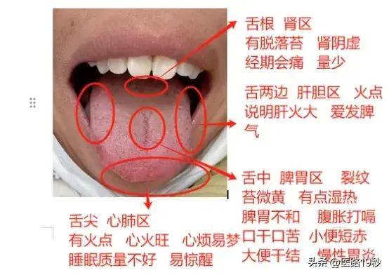 中医舌诊案例分享