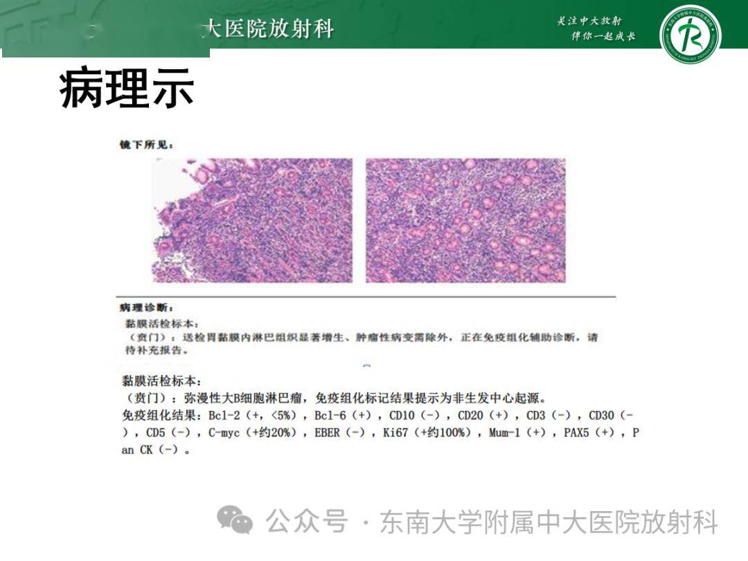 胃黏膜相關淋巴組織(malt)淋巴瘤_全網_影像_解剖圖